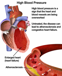 hypertension